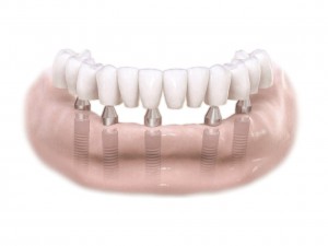 Зубные импланты-01
