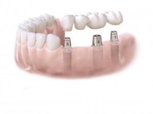 Зубные импланты-03