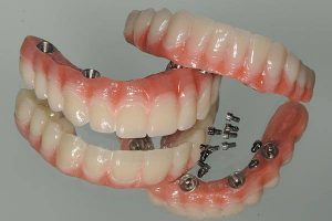 Implant-borne dentures for upper and lower jaw