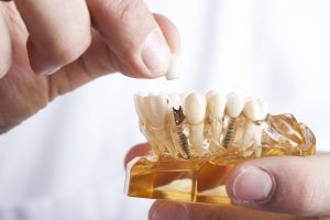 Was sind Zahnimplantate?